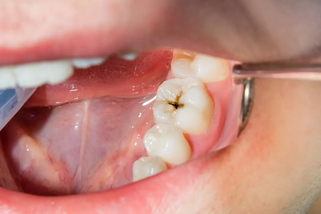 Soins conservateurs et traitement des caries