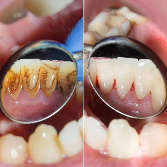 Détartrage prophylactique et polissage